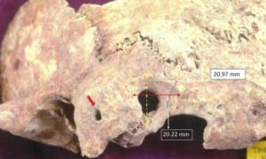 Αρχαιολογική ανακάλυψη στην Θάσο - Κρανίο με ίχνη χειρουργείου  