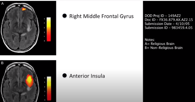 Λοβοτομή μέσω ιών και εμβολίων, με σκοπό την εξουδετέρωση του γονιδίου του Θεού ! της Αναστασίας Παπαδάκη  