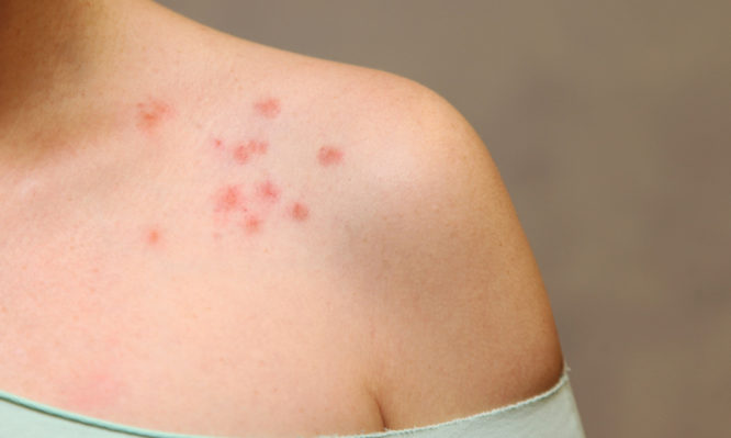 Τα πρώτα 30 λεπτά: Αναφυλαξία μετά το εμβόλιο COVID-19  